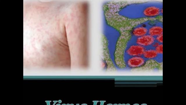 Roseola-Infantum (6. Hastalık) / Uzm. Dr. F.Özden Dizioğlu смотреть онлайн