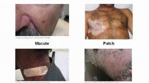 USMLE RX - 8.Анатомия - 2.Дерматология - 4.Дерматологические МАКРОскопические термины