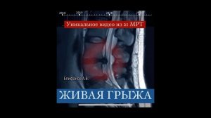 Herniated disc real-time resorption/Рассасывание грыжи без хирургии