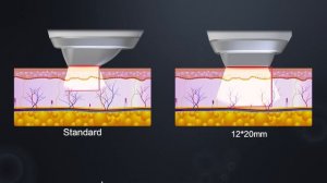 Lasermach Pro | מערכת לייזר חכמה