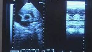 Как проходит УЗИ сердца