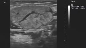 Сиалоаденит