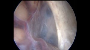 эндоскопическая фенестрация симптомных кист головного мозга