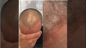 Трихопигментация до и после, делаем волосы визуально гуще