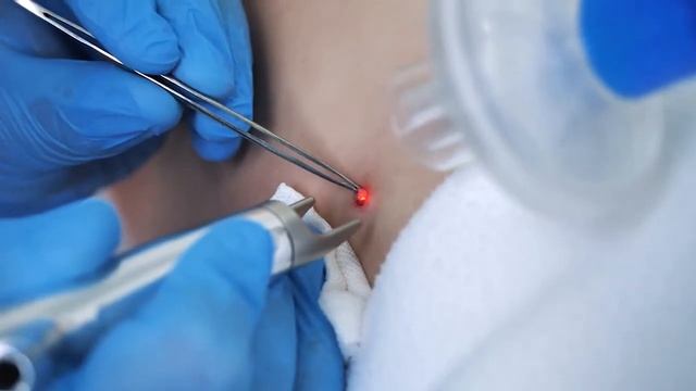 Как проходит удаление родинок? смотреть онлайн