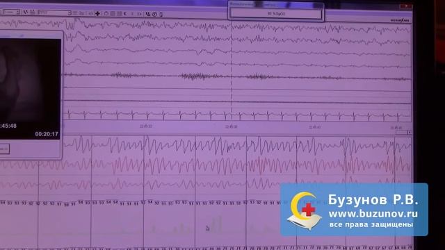 Диагностика синдрома обструктивного апноэ сна с помощью полисомнографии