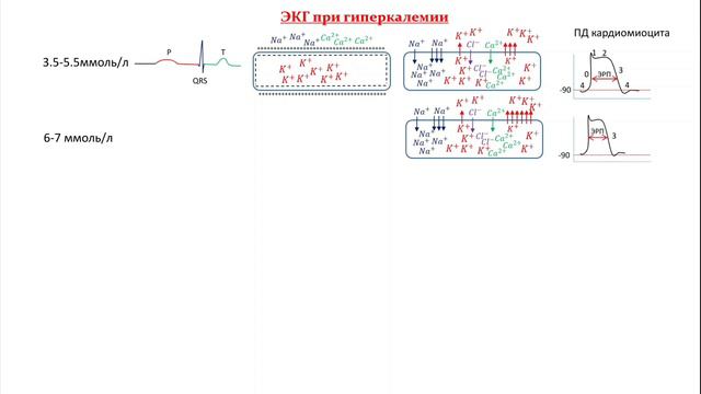 ЭКГ при гиперкалиемии [самое лучшее объяснение]. ECG in hyperkalemia [the best explain]. смотреть онлайн