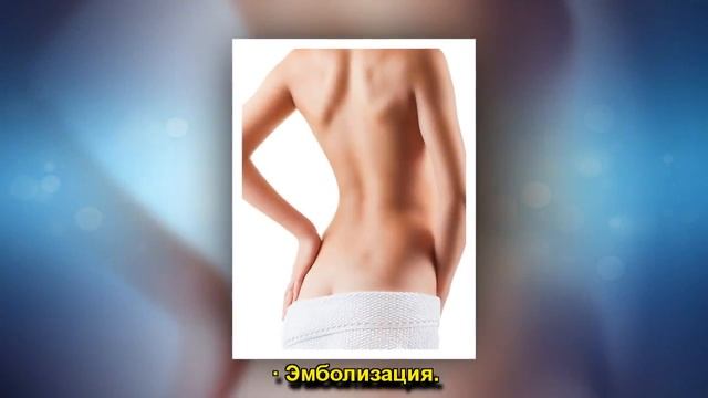 МИОМА МАТКИ смотреть онлайн