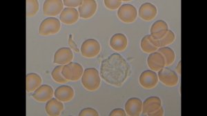 Эритроциты, Пойкилоцитоз, шизоцит, нейтрофил под микроскопом Микмед 6 в 7 гемосканирование