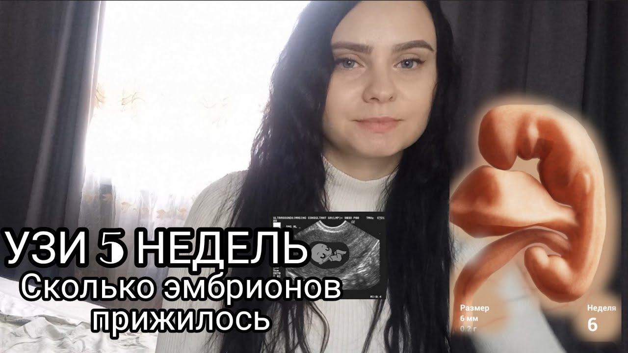 ПЕРВОЕ УЗИ БЕРЕМЕННОСТИ В 5 НЕДЕЛЬ  🤰🏻 Двойня или один ? Результат ЭКО.
