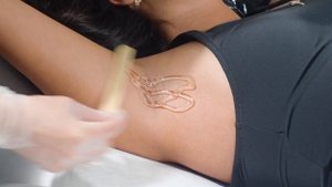 Лазерная эпиляция подмышек