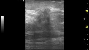 УЗИ Рак молочной железы