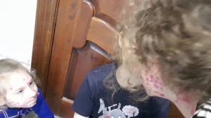 Ветрянка у малышки/ с какими сложностями столкнулись