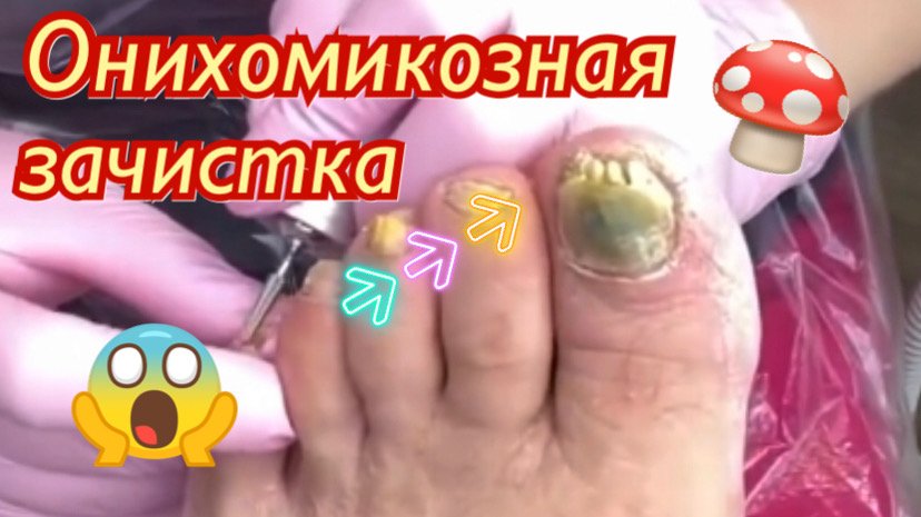Онихомикозная зачистка???⚠️? смотреть онлайн