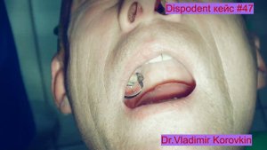 Кейс раббердам Dispodent. Для лечения 16. Кейс #47.