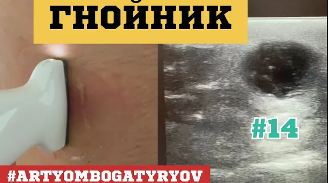 14. Операция_ Вскрытие и дренирование воспаления волосяного фолликула