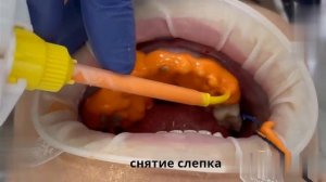 Этапы изготовления циркониевой коронки
