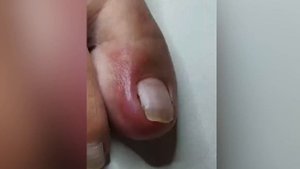 Ноготь??который очень глубоко врос??