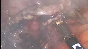 Острый аппендицит (гангренозный перфоративный)  Лапароскопическая аппендэктомия Опер.проф.Э.К.Агаев