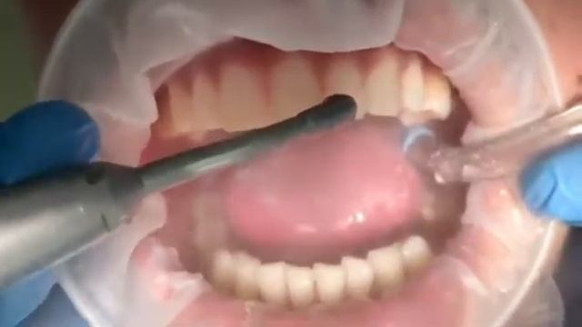 Профессиональная чистка зубов в Евростом+. Якутск.