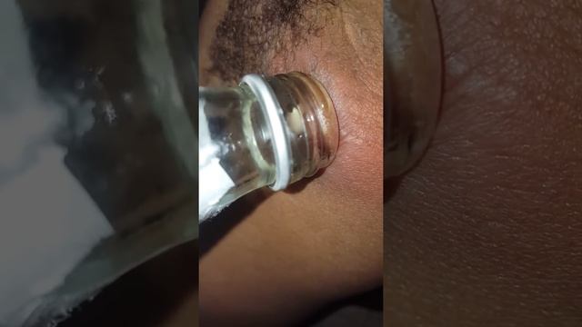 Boil (Cyst) Bottle trick part 1