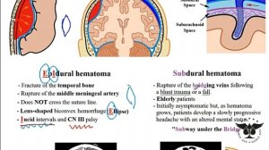 235 - Hemorrhagic stroke, epidural & subdural hematoma - USMLE Step 1 - USMLE ACE