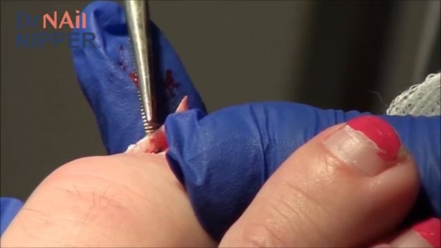 Dr Nail Nipper Explains an Ingrown Toenail [Throwback Thursday Bonus] смотреть онлайн