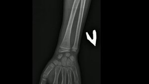 Медицина онлаин #перелом лучевой кости без смещения  #рентген  #анатомия