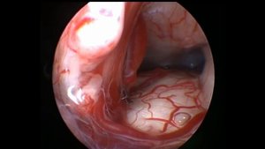 Селективная эндоскопическая вестибулотомия (нейрохирургическое лечение болезни Меньера)