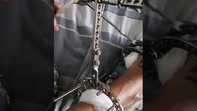 Как подкручивать аппарат илизарова?! смотреть онлайн