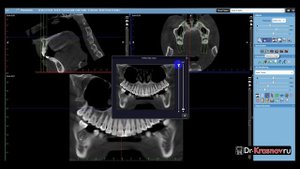 Использование панорамного модуля для диагностики КЛКТ в Planmeca Romexis
