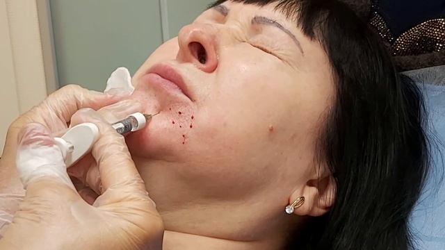 АирисКом студенты учатся: семинар для студентов применение филлера.