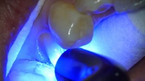 Pre Heated CompositeResin Cementation