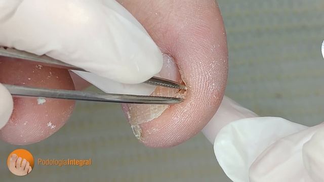 Bye bye nail discomfort! Welcome total cleaning! [Podología Integral] смотреть онлайн