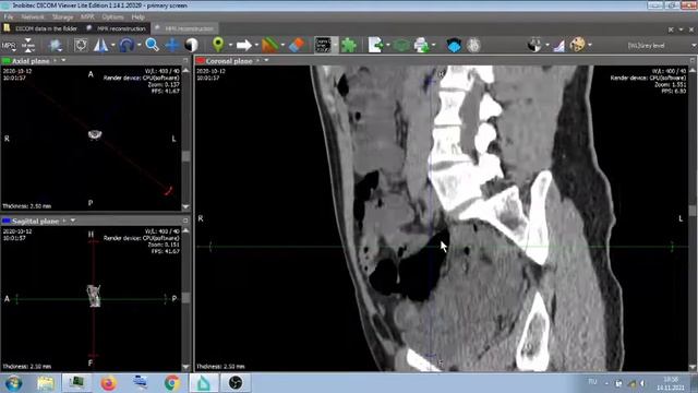 КТ БРЮШНОЙ ПОЛОСТИ С "ПОДГОТОВКОЙ" АНГИОГРАФИЯ . смотреть онлайн