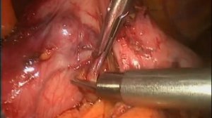 ЛАПАРОСКОПИЧЕСКОЕ УДАЛЕНИЕ GIST ЖЕЛУДКА