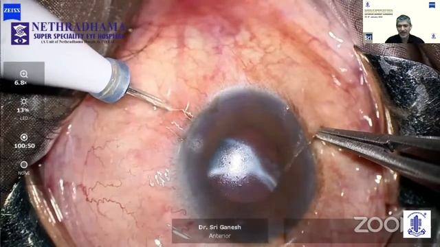 ANTERIOR SEGMENT SURGERIES смотреть онлайн