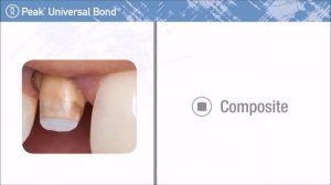 Ultradent’s Versatile Universal Dental Bonding Adhesive