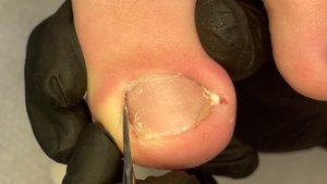 Удалить осколок ногтя после травмы