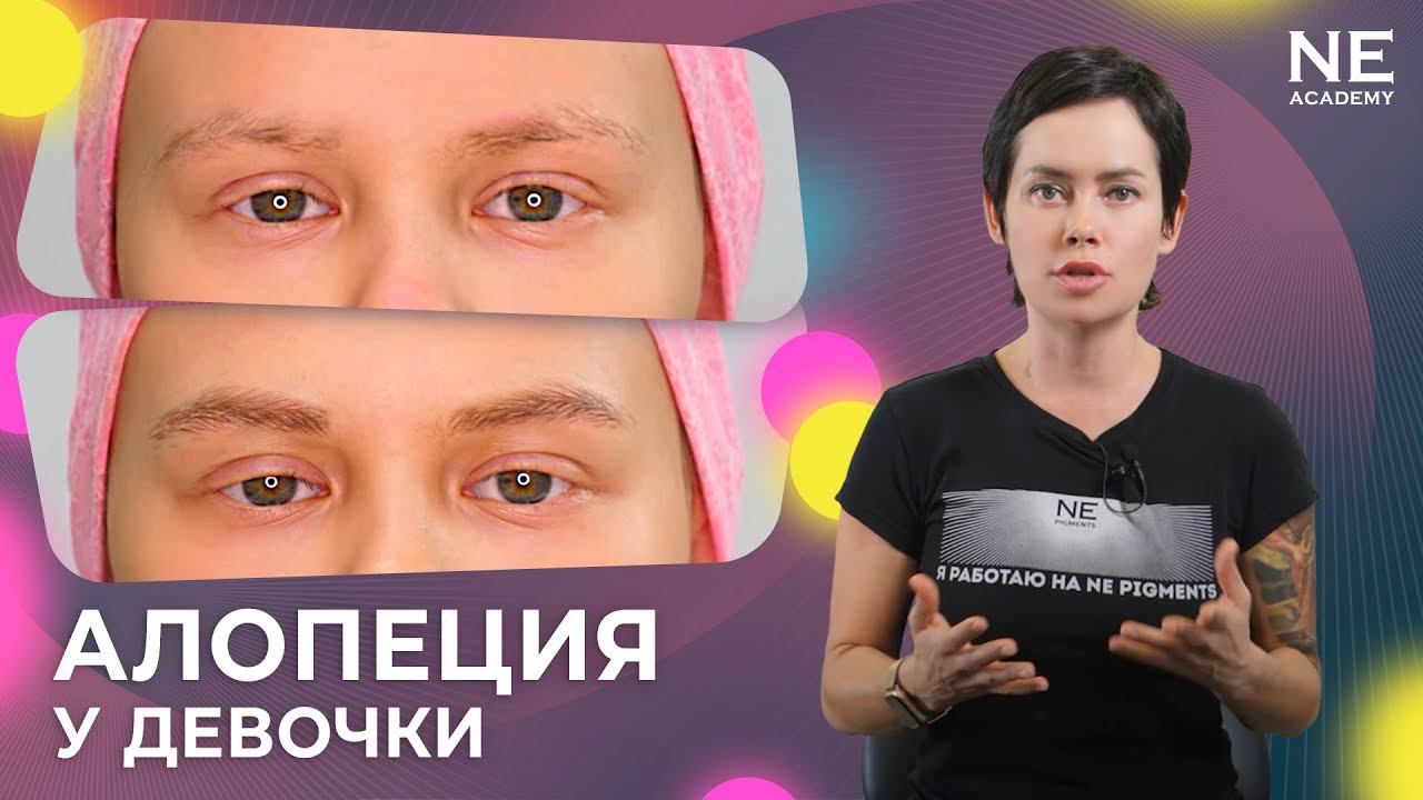Алопеция у девочки. Волосковый татуаж бровей.