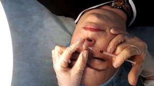 Удаление внутридермального невуса на носу