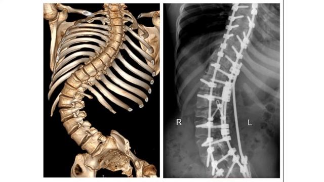 S-подібний сколіоз. Як робити масаж при сколіозі. смотреть онлайн