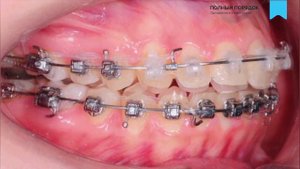 Прогресс в лечении открытого прикуса брекетами Damon за 18 месяцев