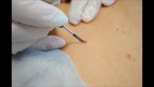 Удаление новообразований/Клиника косметологии «8 ЧУДО» смотреть онлайн