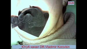 Одиночная изоляция 47 зуба.  Платок Sanctuary Black medium.
