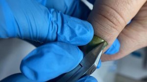 Синегнойная палочка / Сигегнойка / Позеленел ноготь / Онихолизис