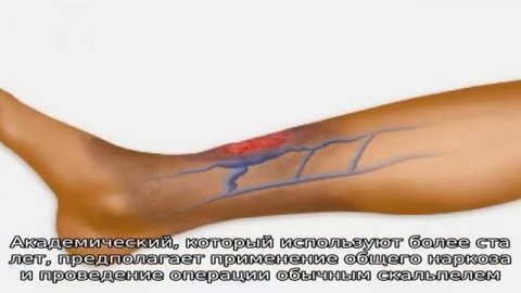 Что такое флебология?