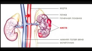 Киста почки