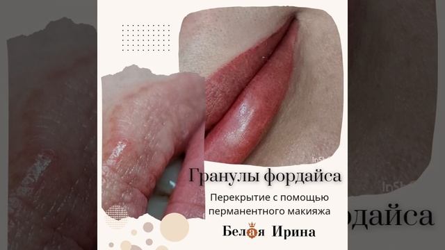 Гранулы Фордайса - перманентный макияж губ