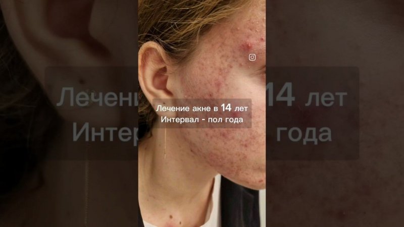 акне - проблема к которой необходим индивидуальный подход! #shortsvideo #shortsvideo #акне #лечение